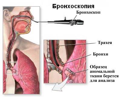 bronhoskop