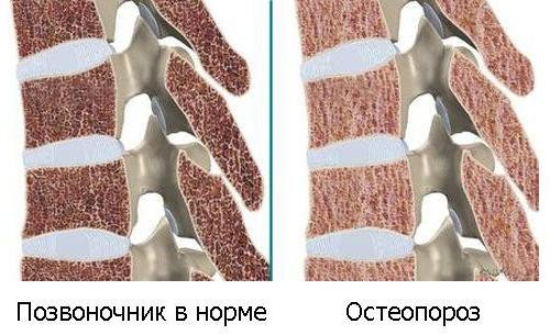 simptomy osteoporoz1